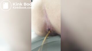 watery diarrhea and fart