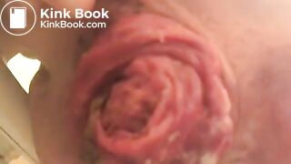 prolapse and shit23