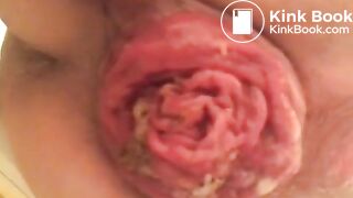 prolapse and shit23