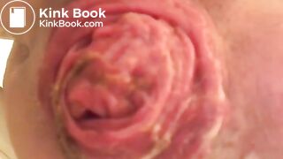 prolapse and shit23