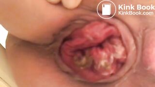 prolapse and shit23