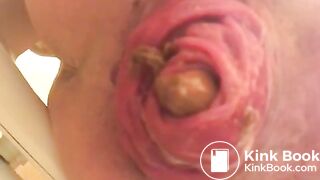 prolapse and shit23