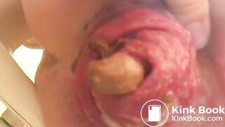 prolapse and shit23