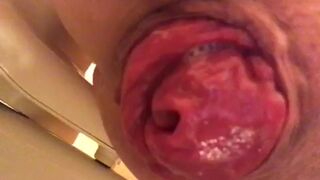 prolapse and shit18