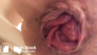 prolapse and shit18