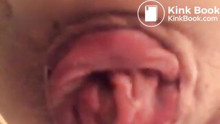 prolapse and shit18