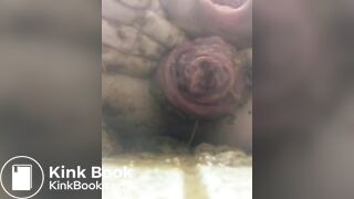 prolapse and shit16
