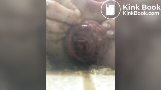 prolapse and shit16