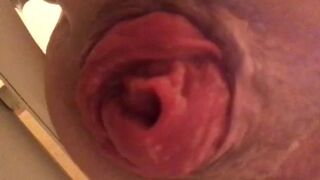 prolapse and shit14