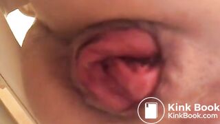 prolapse and shit14