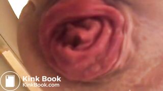prolapse and shit14