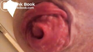 prolapse and shit14
