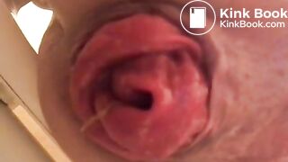 prolapse and shit14