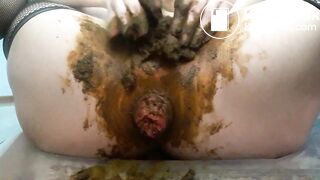 Scat anal prolapse video
