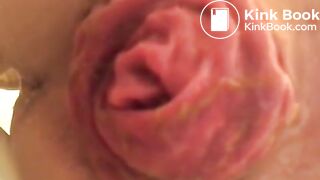 prolapse and shit6