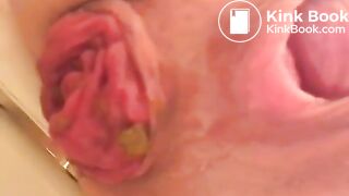 prolapse and shit6