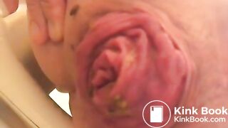 prolapse and shit5