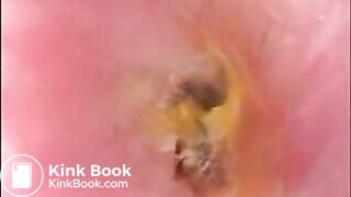 Camera in Arse with poo Asian. Buttcam