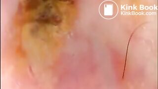 Camera in Arse with poo Asian. Buttcam