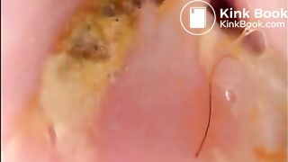 Camera in Arse with poo Asian. Buttcam