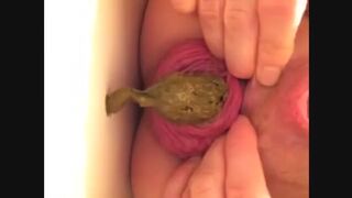 Prolapse and shit, my two favourites