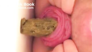 Prolapse and shit, my two favourites