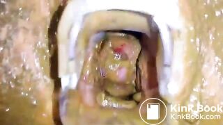 Speculum full of poop - part 3