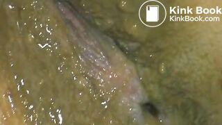 Hot m*aria diarrhea farting