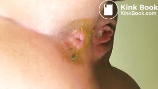 Girl's has a yellow diarrhea