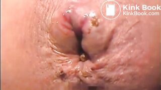 Volcano full of hot turds