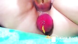 prolapse 2 poo