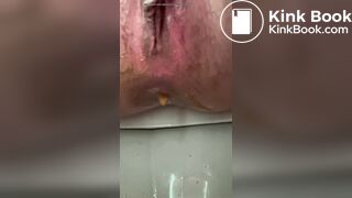 diarrhea 7 times