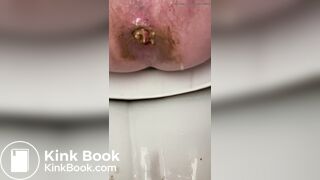 diarrhea 7 times