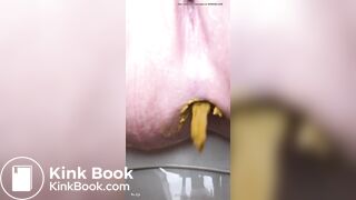 Soft diarrhea close up girl