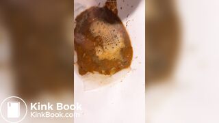Chinese girl have watery diarrhea1