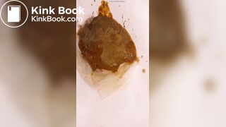 Chinese girl have watery diarrhea1