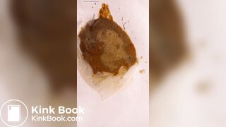 Chinese girl have watery diarrhea1